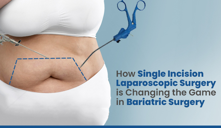 How Single Incision Laparoscopic Surgery is Changing the Game in Bariatric Surgery