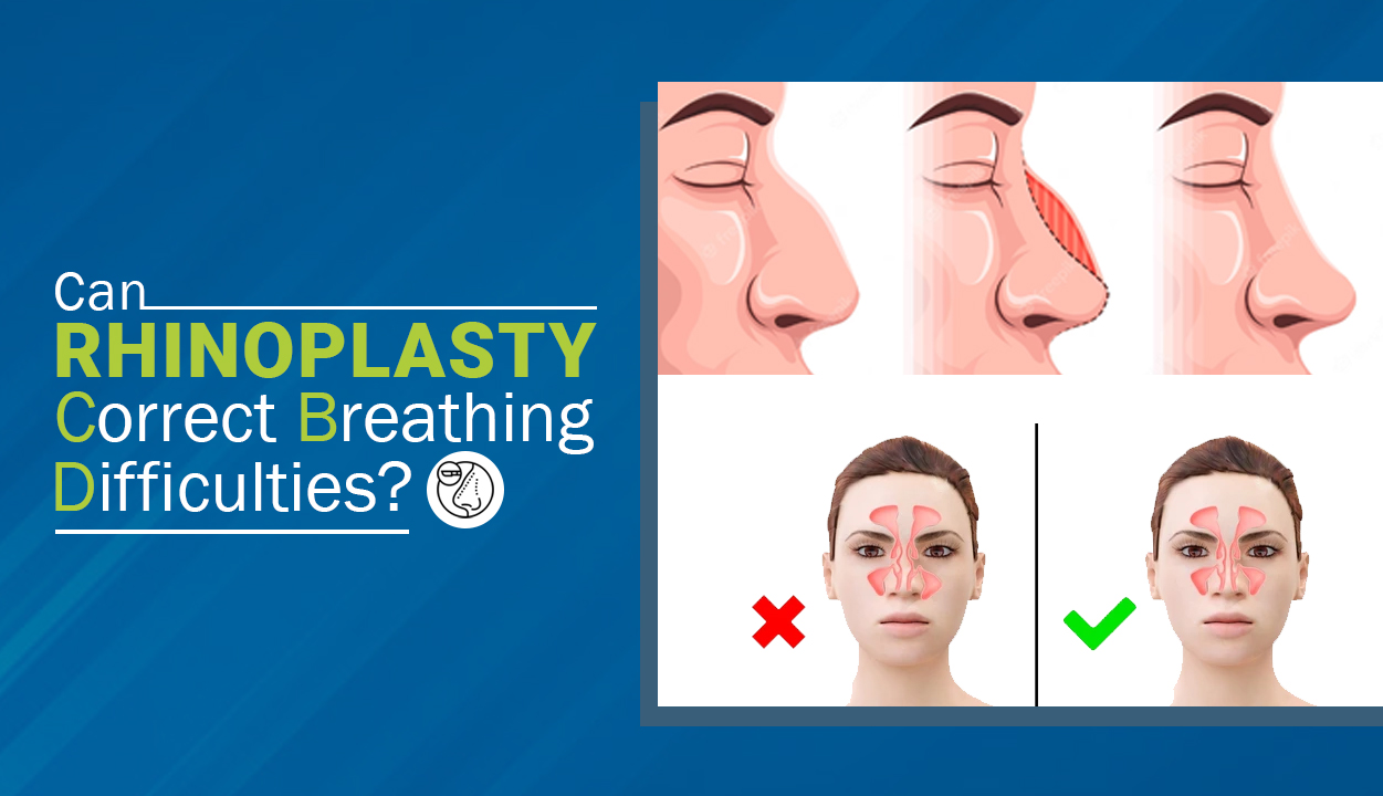 Can Rhinoplasty correct breathing difficulties