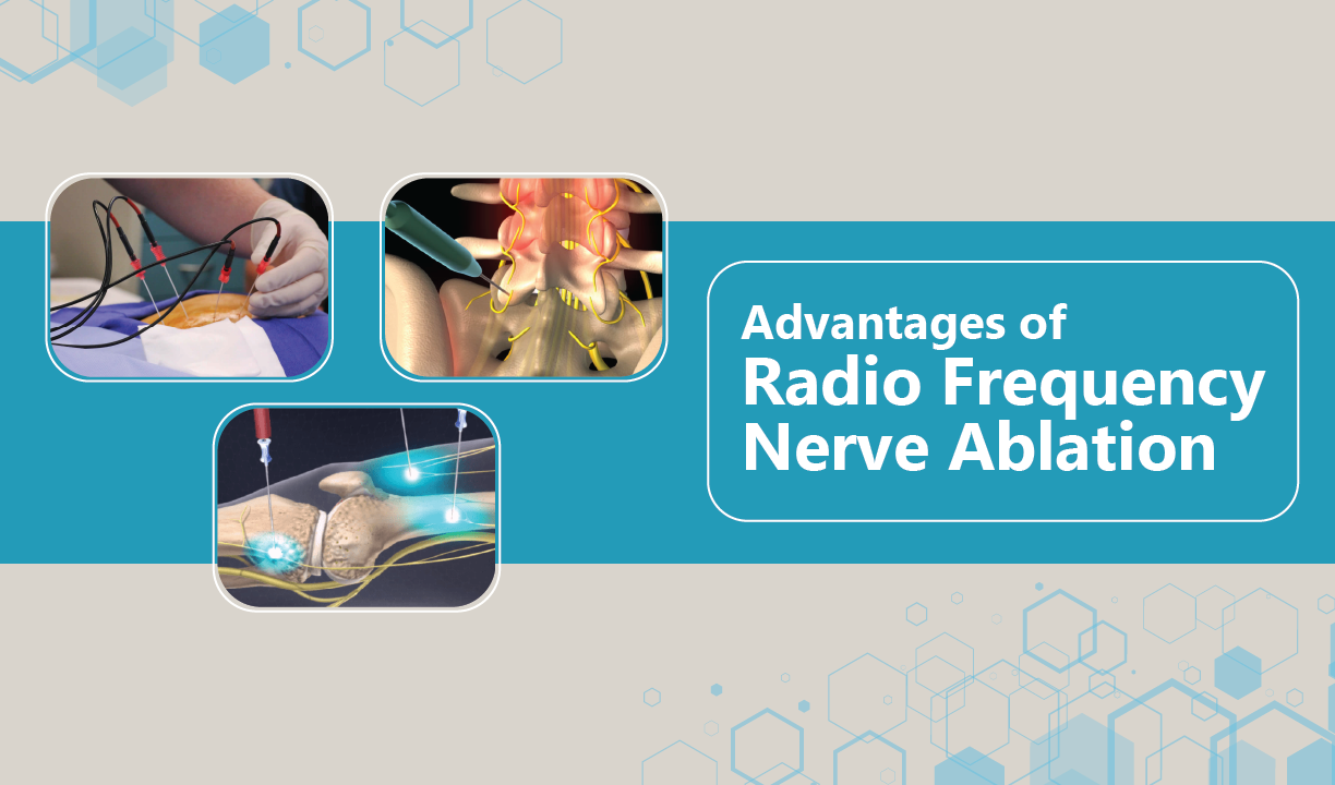 Advantages of Radio Frequency Nerve Ablation