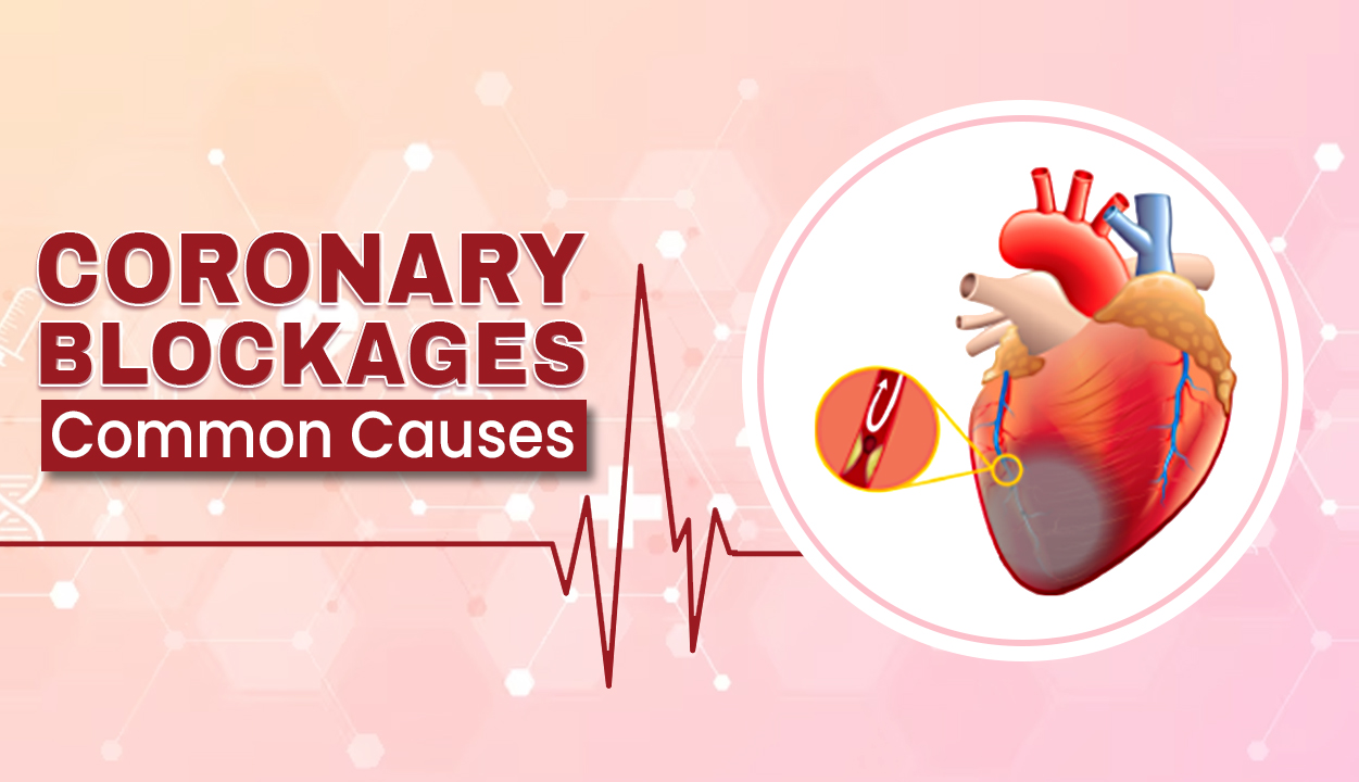 Coronary Blockages Common Causes