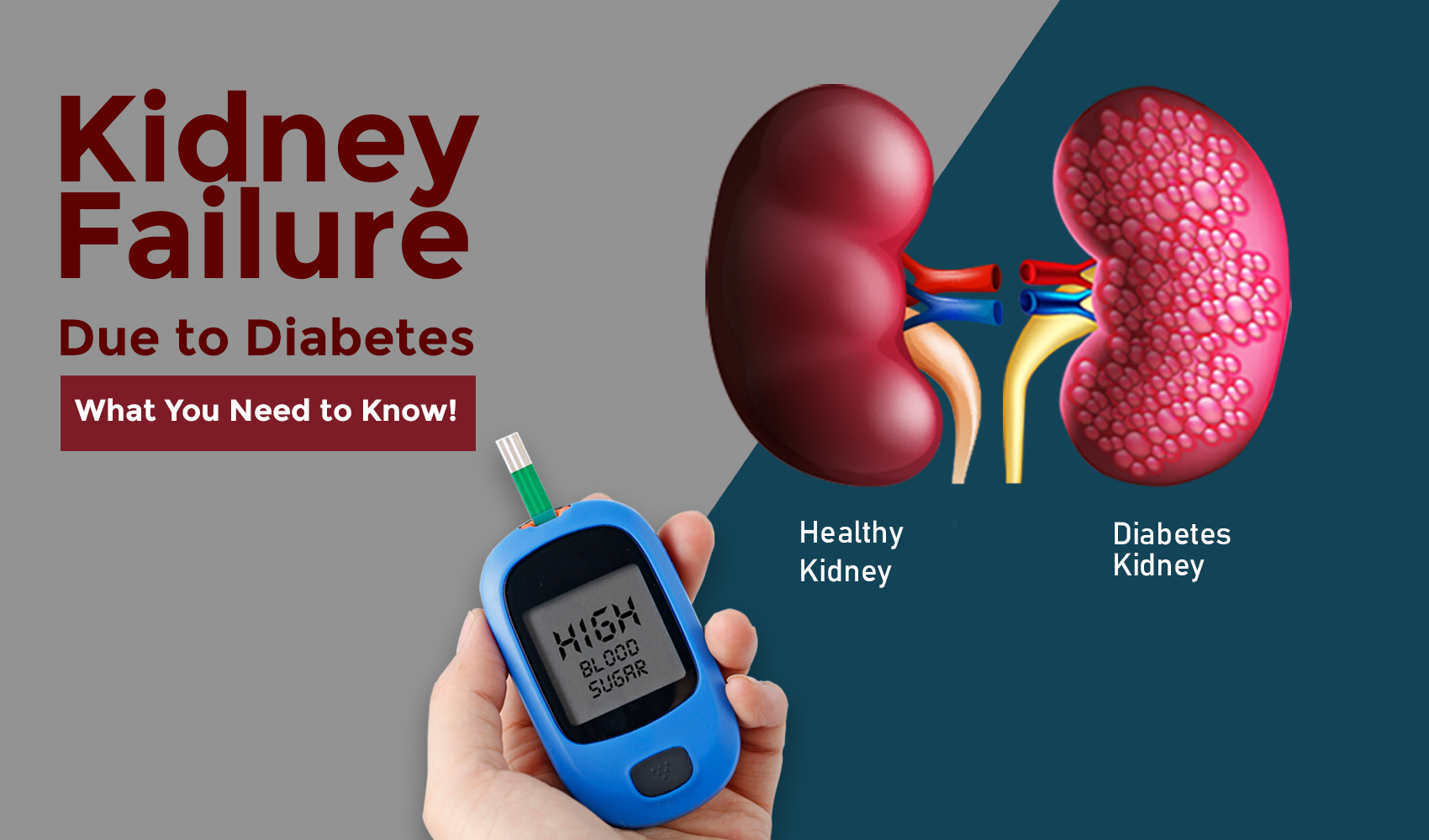 Kidney failure due to diabetes – What you need to know!