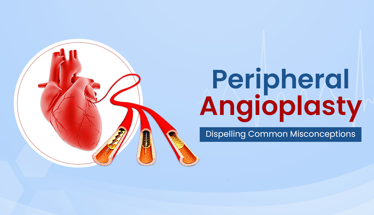 Peripheral Angioplasty Dispelling Common Misconceptions