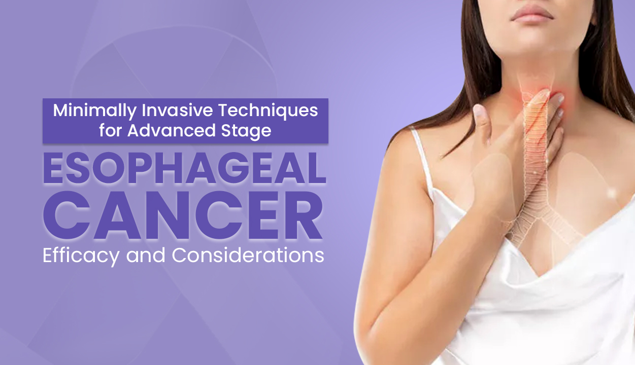 Minimally Invasive Techniques for Advanced Stage Esophageal Cancer Efficacy and Considerations