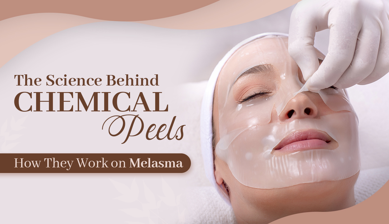 Chemical_peels_for_melasma