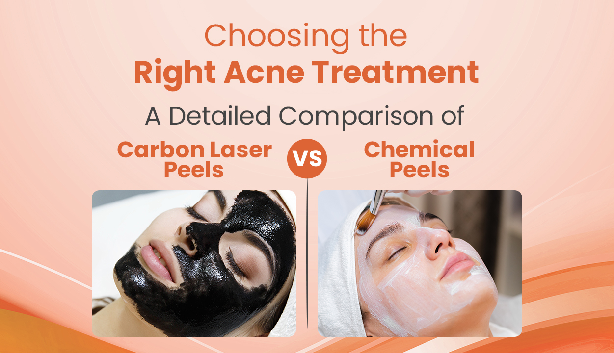 Right_acne_treatment_carbon_laser_peels_chemical_peels