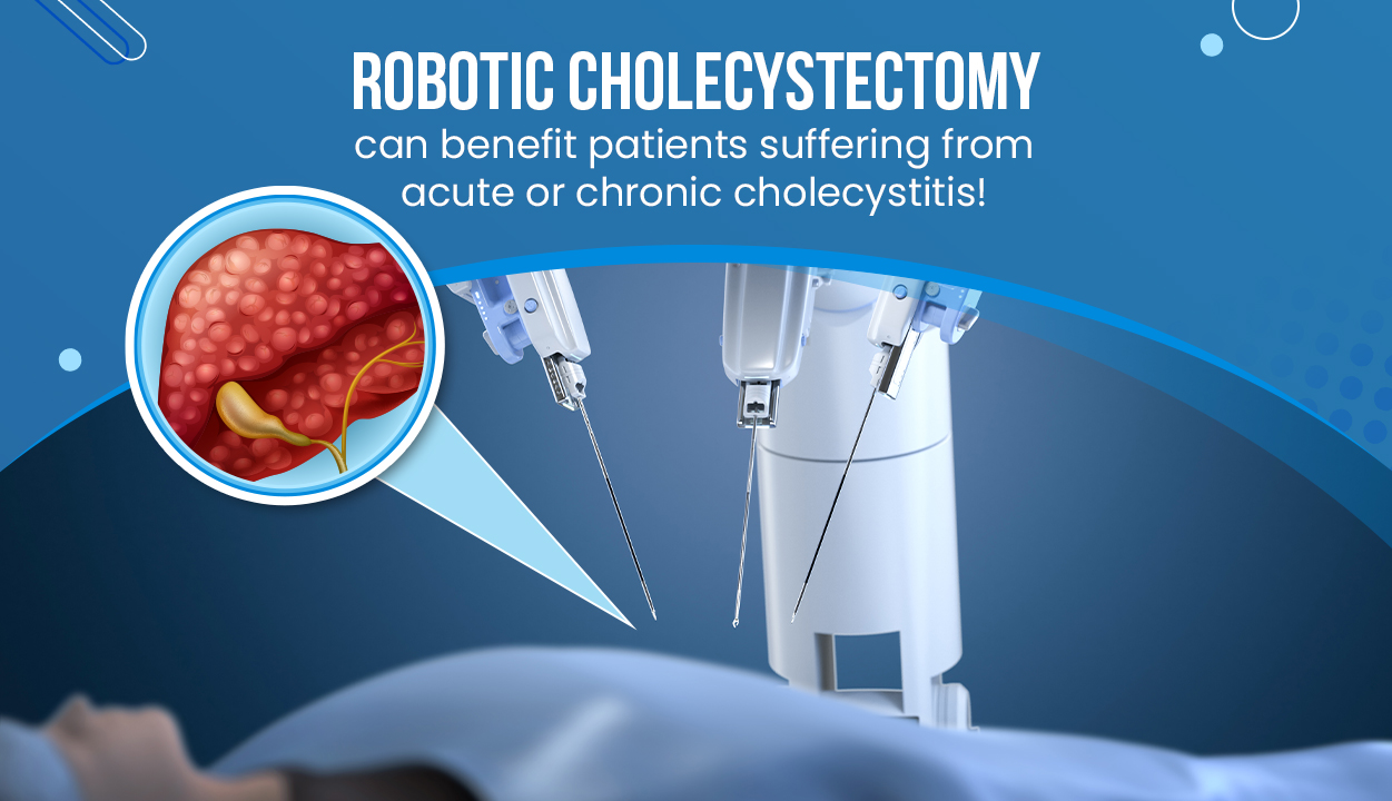Robotic_cholecystectomy_Gall_bladder_surgery