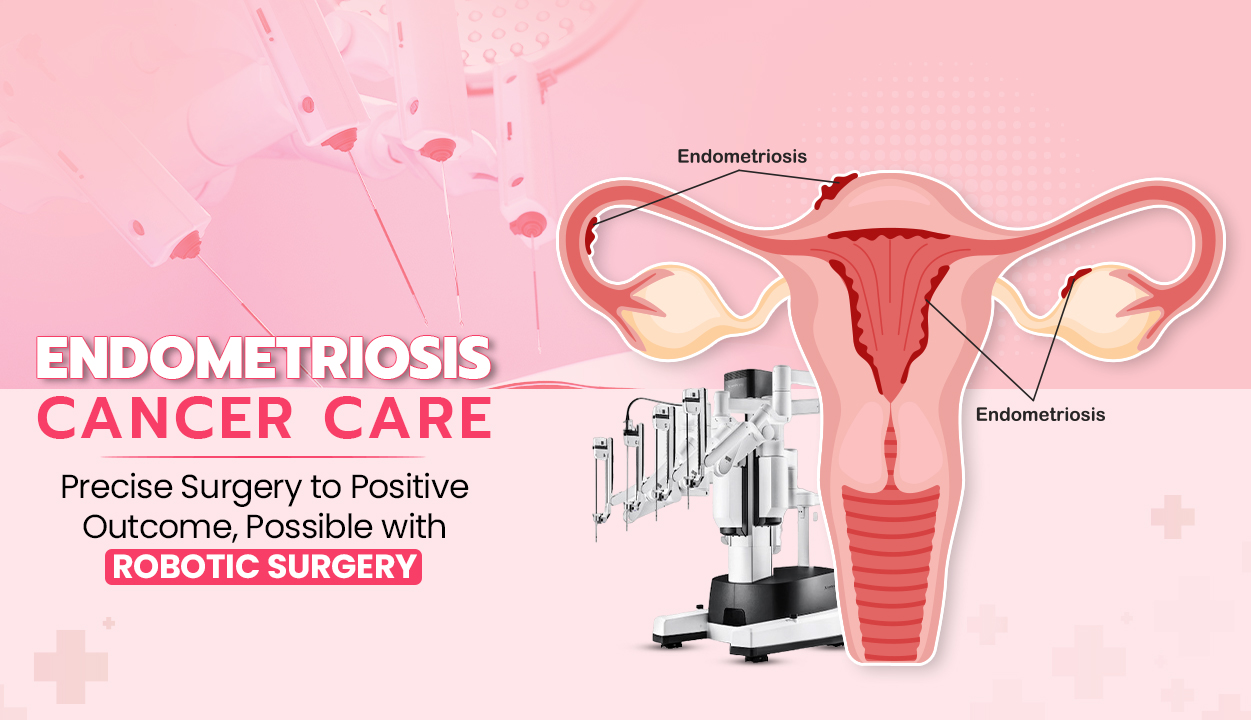 Endometriosis Cancer Care – Precise Surgery to Positive Outcome, Possible with Robotic Surgery