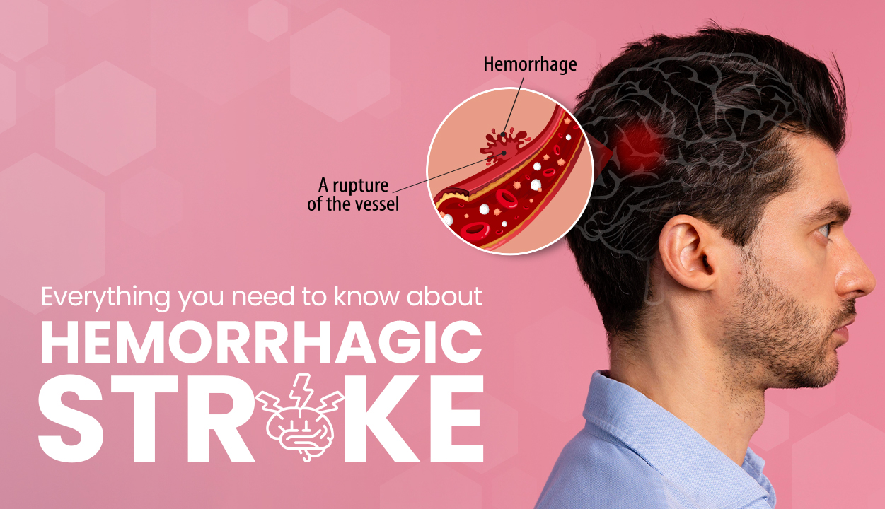 Everything you need to know about Hemorrhagic Stroke