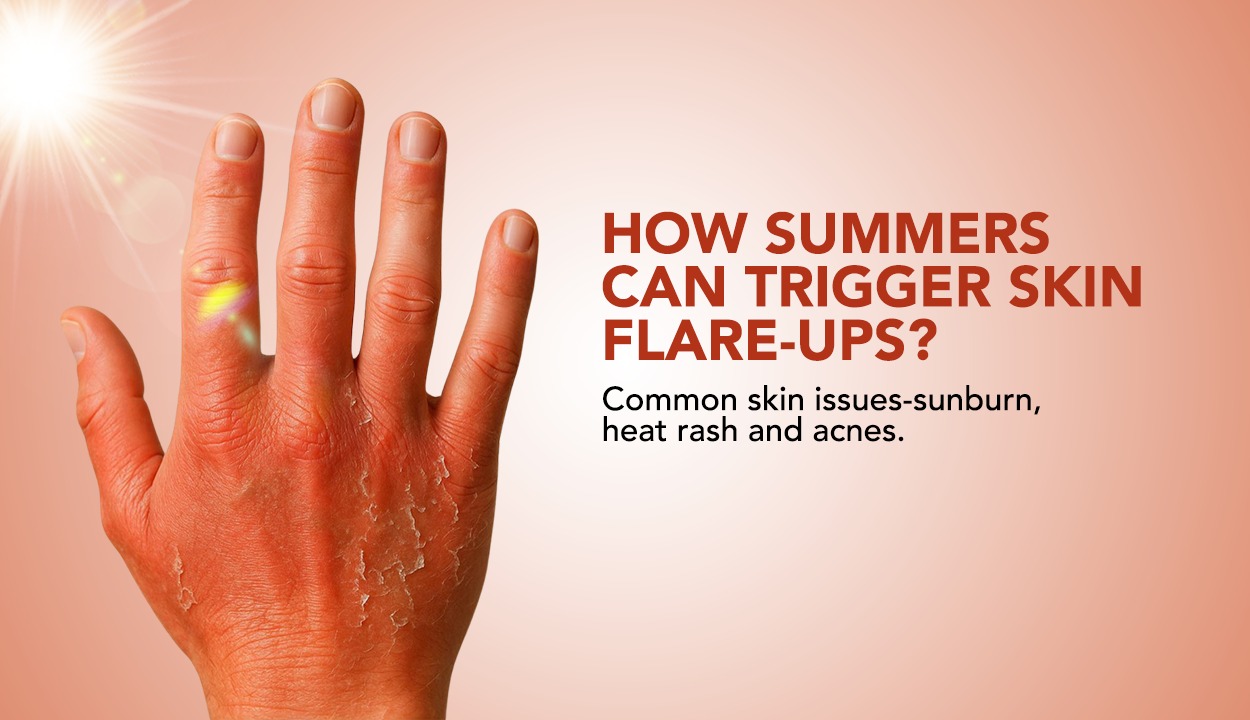 Summer Skin SOS: How to Tackle Sunburn, Heat Rashes, and Acne in Summer!