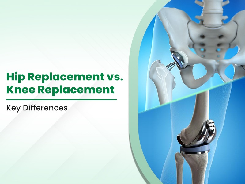 Hip Replacement vs. Knee Replacement: Key Differences