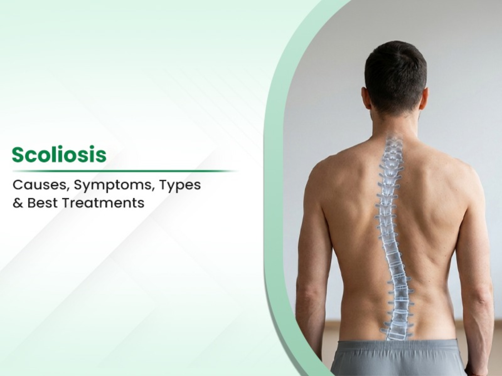 Scoliosis: Causes, Symptoms, Types & Best Treatments
