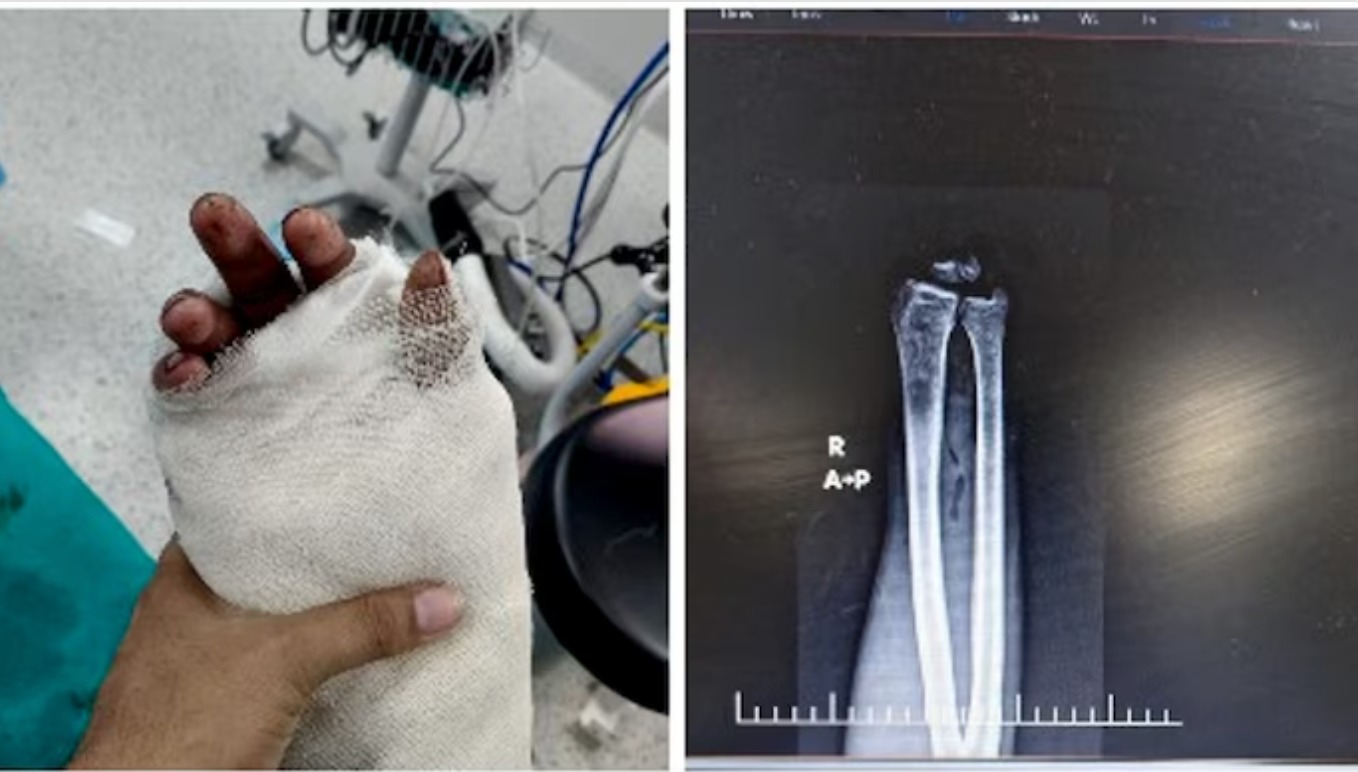 His wrist was severed in an accident. Doctors reattached it in a 7-hour surgery